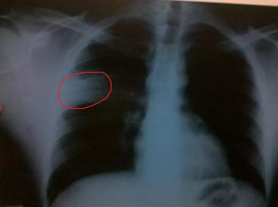 ASÍ ATACA. La infección pulmonar comienza días después de un resfrío o dolor de garganta y se diagnostica con examen físico y radiografía de tórax. DEDELBERG.COM.AR 