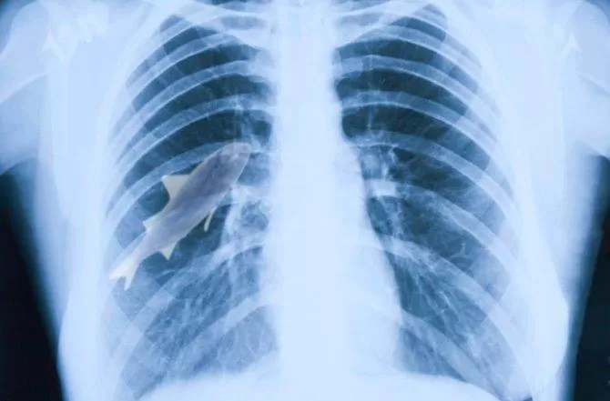 EN SU CUERPO. El pez quedó en el pulmón. FOTO TOMADA DE ABC.ES