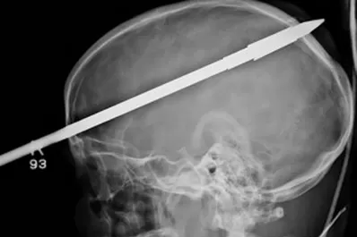 Un arpón atravesó su cabeza y sobrevivió