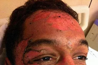 Así quedó Thiago, el modelo que se prendió fuego en pleno show en Chile