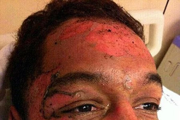 Así quedó Thiago, el modelo que se prendió fuego en pleno show en Chile