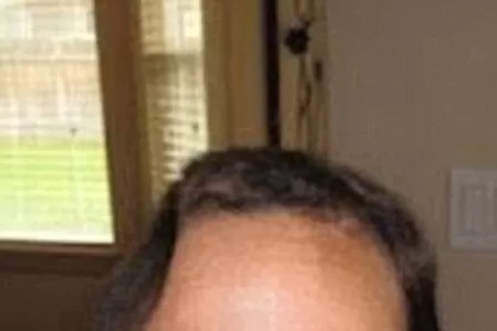 SONRIENTE. Jamie Hilton, sin parte de su cráneo. FOTO TOMADA DE DAILYMAIL.CO.UK