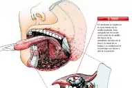 Médicos tucumanos extirparon un cáncer oral y reconstruyeron la cavidad bucal de la paciente