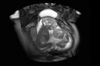 Filman a gemelos peleando dentro del útero de su madre