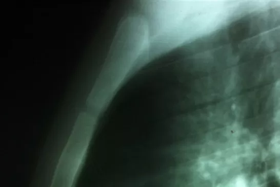 SITUACIÓN COMPLICADA. El equipo tenía que evitar que se agrande la herida. FOTO DEL MINISTERIO DE SALUD DE LA NACIÓN.