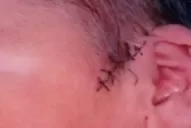 Salta: médicos cortaron en la cabeza a un bebé en una cesárea