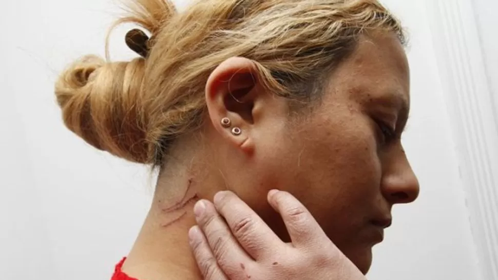 MARCAS. Albarracín muestra las huellas del ataque. FOTO TOMADA DE ELTRIBUNO.INFO