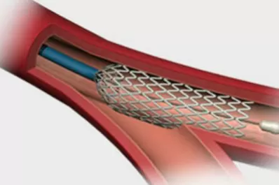Se cumplen 25 años de la creación del stent, un invento argentino