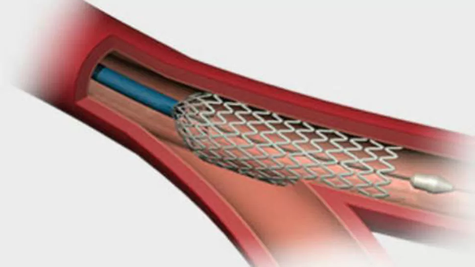 TECNOLOGÍA. Stent coronario con aplicador de metal sin recubrir. FOTO TOMADA DE LACAPITAL.COM.AR