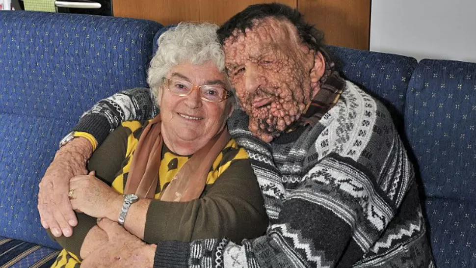 HISTORIA. Vinicio Riva tiene 53 años y sufre neurofibromatosis. IMAGEN TOMADA DE DAILYMAIL.CO.UK