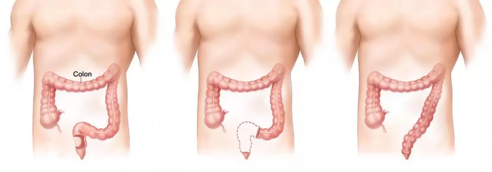 TUMOR MALIGNO. Estos gráficos ilustran cómo fue la cirugía del transportista Oscar de Gaetano: le extirparon un tumor de 4 cm más una parte del intestino grueso donde estaba ubicado. 