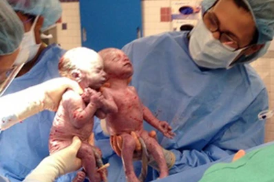 Gemelas conmueven al mundo al nacer tomadas de la mano