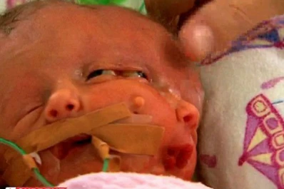 Nacen mellizas con el mismo cuerpo y dos rostros