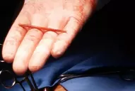 A un hombre le extrajeron un escarbadientes del corazón