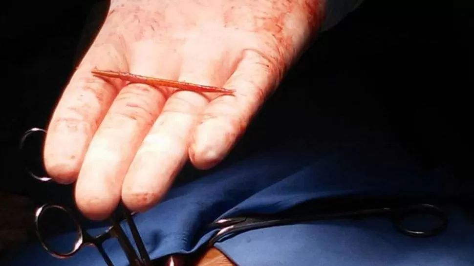 Parece un caso del Doctor House, dijo el médico que operó al hombre del palillo en el corazón