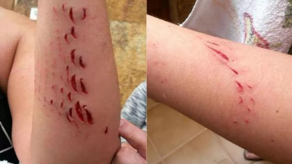 Así le quedó el brazo a una mujer tras ser mordida por un tiburón