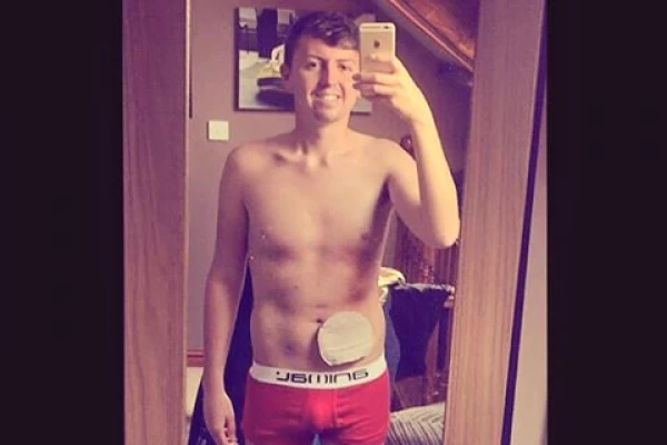 Con una selfie mostró cómo vive con su colostomía y se hizo viral