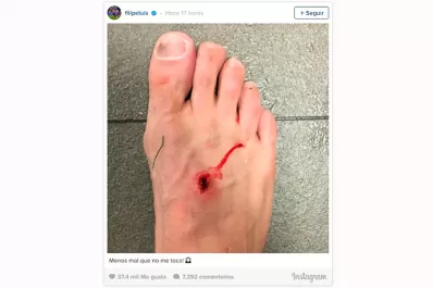 Así le quedó el pie al jugador de Atlético Madrid tras la patada de Luis Súarez