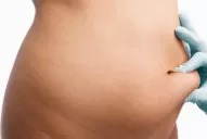 Prevení los riesgos de la liposucción