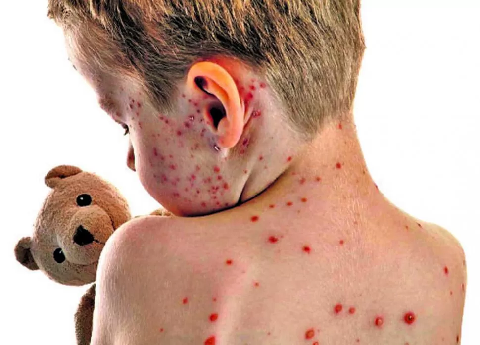 GRUPOS DE RIESGO. Los niños son los más propensos a contagiarse. MOJABR