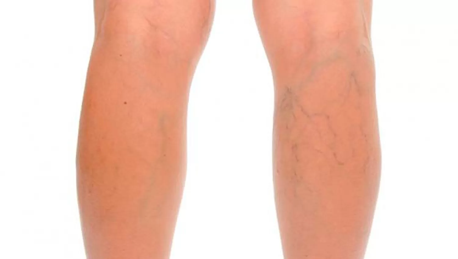 VÁRICES. La actividad física es tu mejor aliada.  FOTO TOMADA DE WEBCONSULTAS.COM