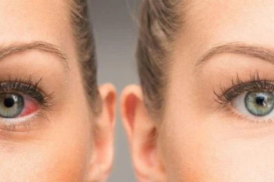 Glaucoma: el ladrón silencioso de la vista