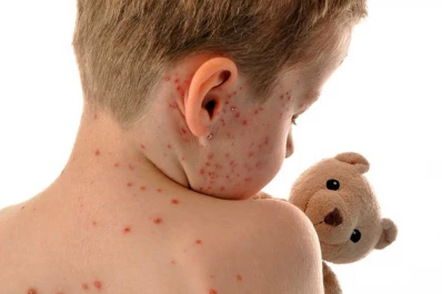 Sarampión: del riesgo a la realidad