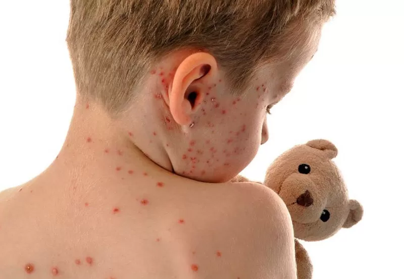 Sarampión: del riesgo a la realidad