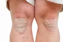 ¿Cómo afecta la psoriasis en momentos de pandemia y de estrés?