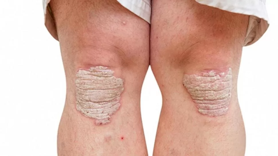 PADECIMIENTOS. La psoriasis, que no es contagiosa, se manifiesta en la piel. 