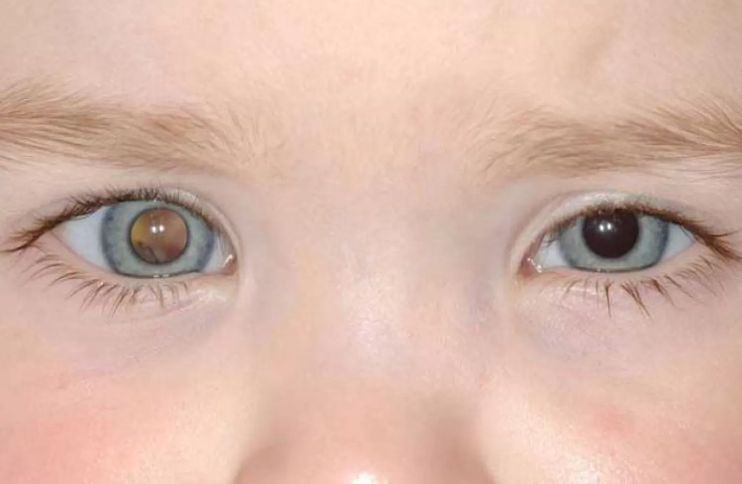 SALUD. Retinoblastoma en niños.