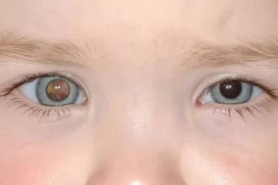 Identificaron un método para prevenir la diseminación del cáncer ocular más frecuente en niños