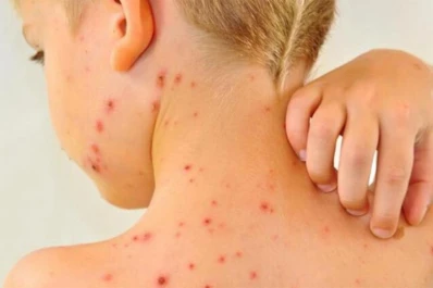 Dengue y sarampión: afirman que Tucumán no presenta casos, pero hay preocupación