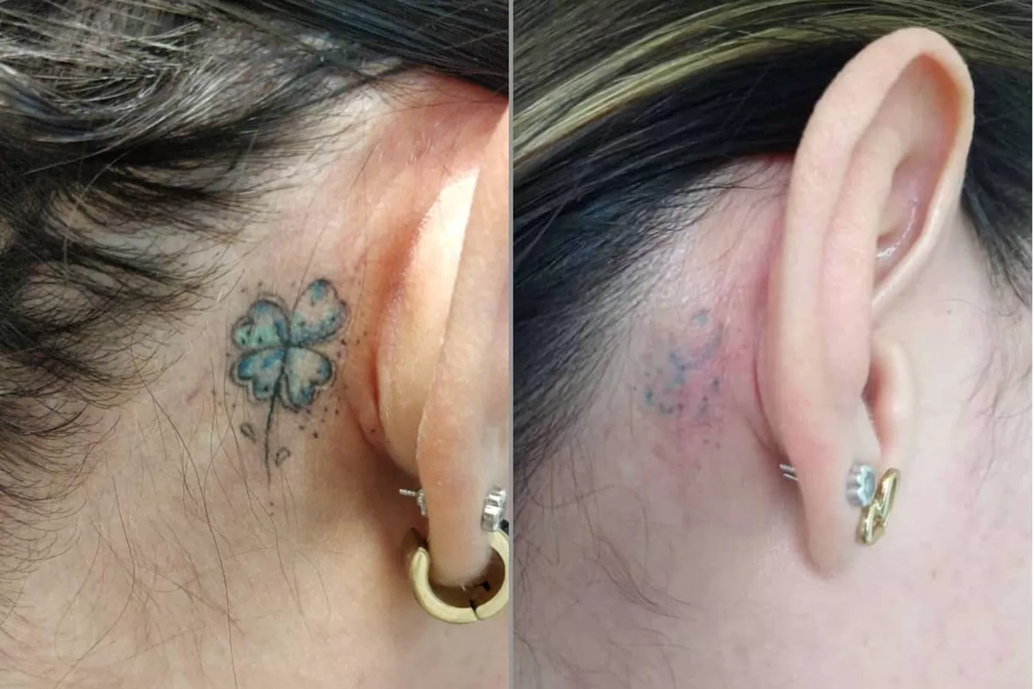 Diferentes opciones para borrar ese tatuaje que ya no querés