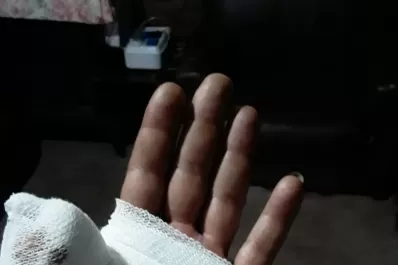 Asalto a un colectivero: “fue traumático perder un dedo; estoy yendo a terapia”