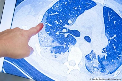 Un tercio de contagiados de coronavirus sufre problemas neurológicos o psicológicos posteriores