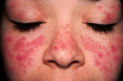 Lupus: enfermedad autoinmune que afecta las mujeres jóvenes