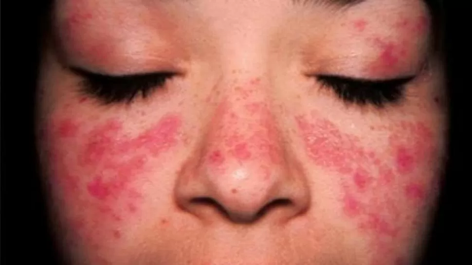DEFINICIÓN. Según un especialista, el lupus es una enfermedad crónica y seria pero necesariamente grave.  