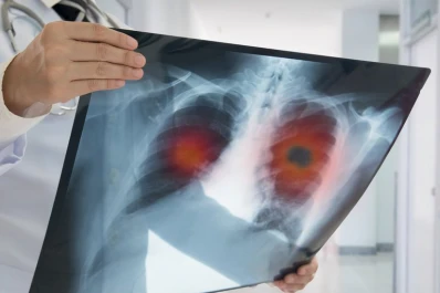 Principales síntomas del cáncer de pulmón