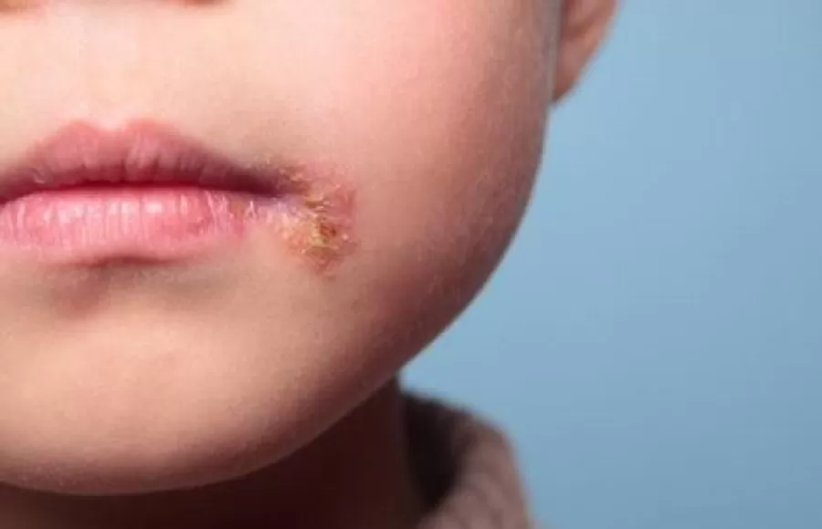 Herpes Bucal: una especialista tucumana explica qué es y cómo identificarlo
