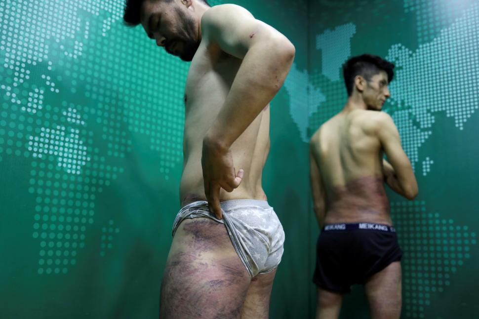 KABUL. Dos reporteros muestran los golpes que les dieron los talibanes. 