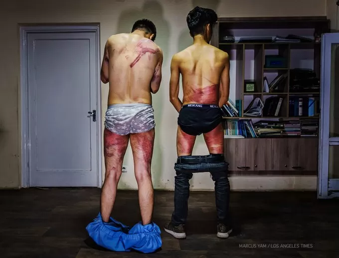MORETONES. Naqdi y Daryabi mostraron los efectos en el cuerpo a causa del trato violento que recibieron.  