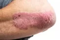 Especialista tucumana resalta la importancia de diagnosticar y tratar a tiempo la Psoriasis