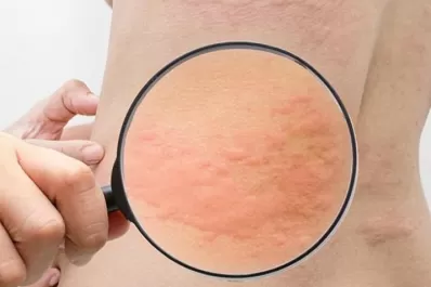 Las alergias más frecuentes y cómo detectarlas