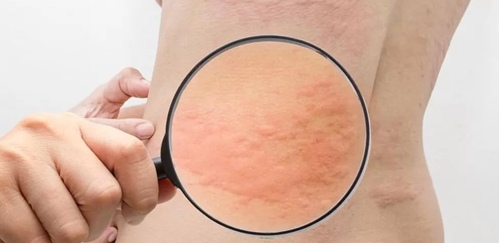 Las alergias más frecuentes y cómo detectarlas