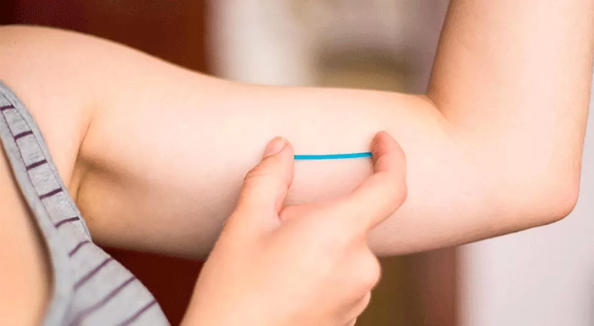 Una especialista tucumana explica qué es un implante anticonceptivo subdérmico