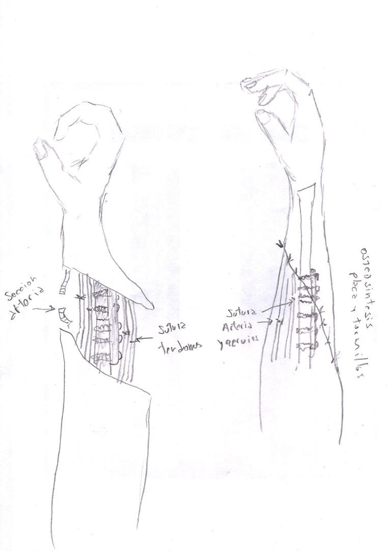 EL REIMPLANTE. Los dibujos a mano alzada del doctor Urpi mostraron con precisión el lugar donde fueron los cortes en el accidente. 