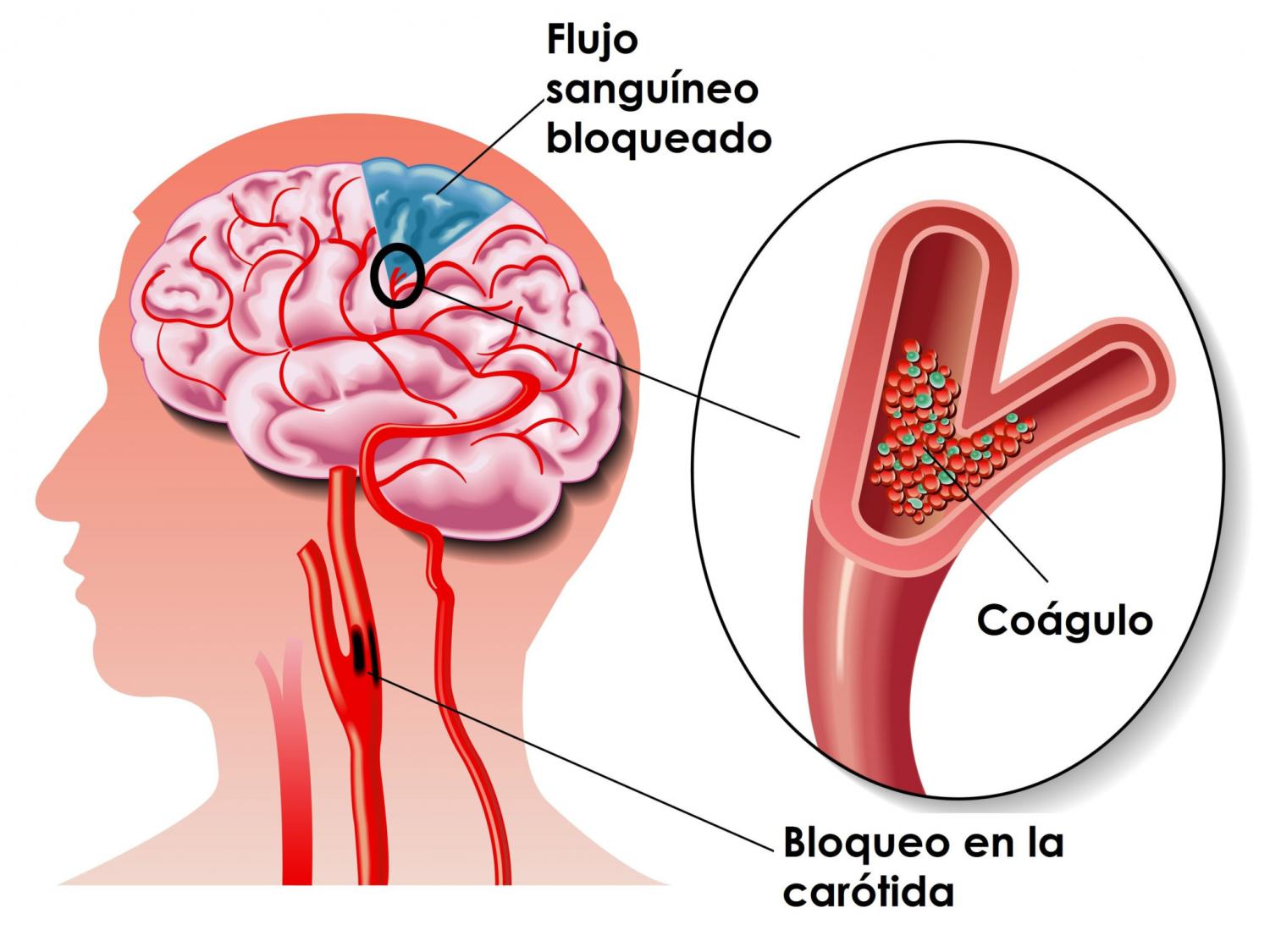 Síntomas del ictus