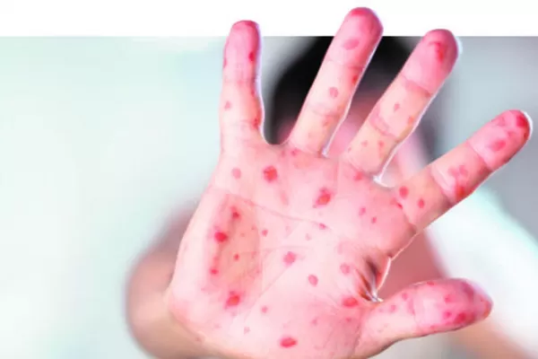 Confirman un caso de sarampión importado en la Ciudad de Buenos Aires