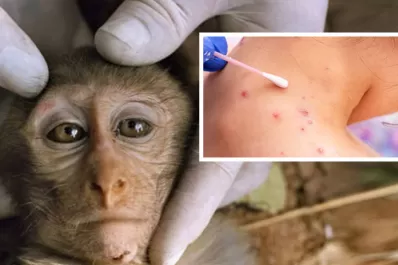 La viruela del mono se expande por más países de Europa